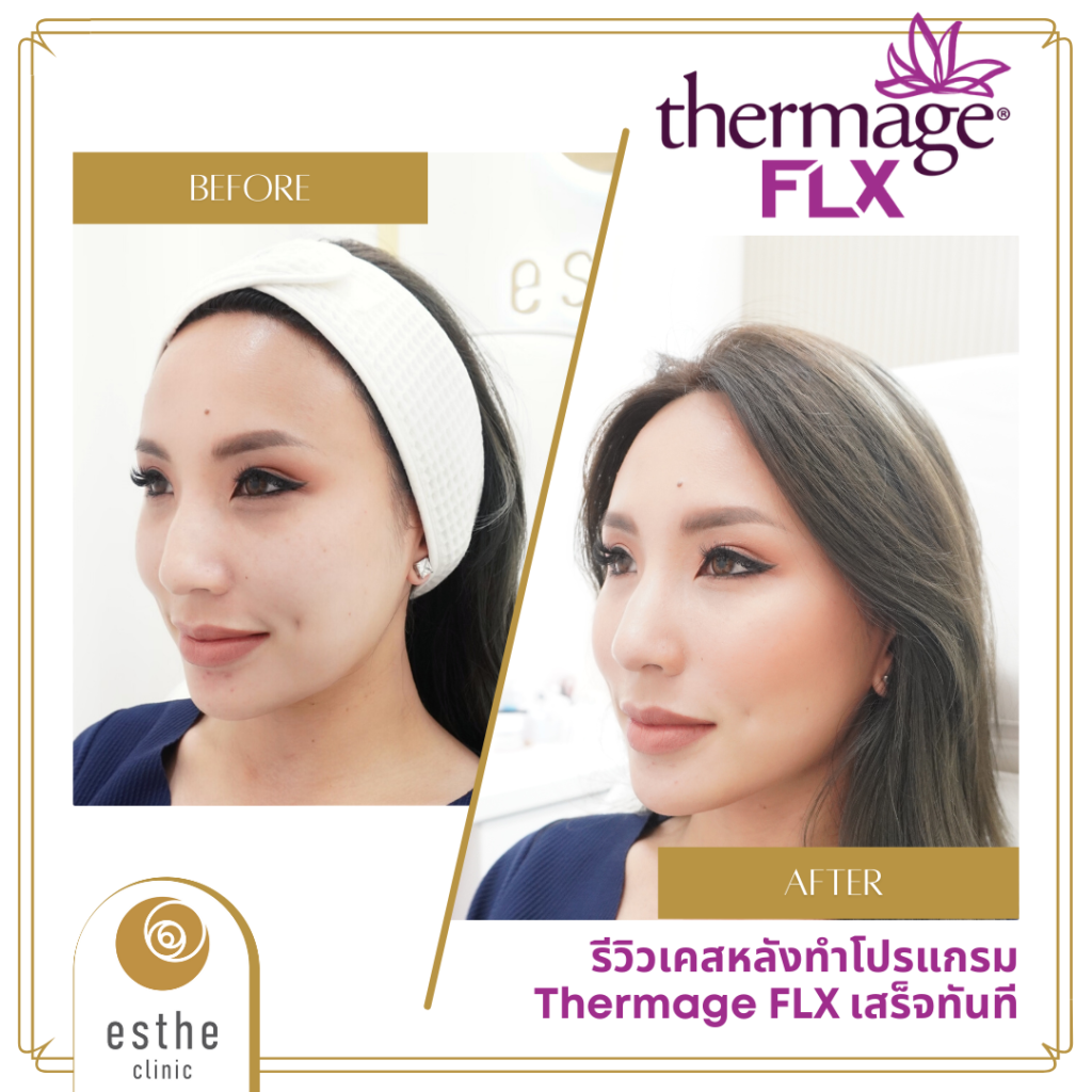 new thermage flx